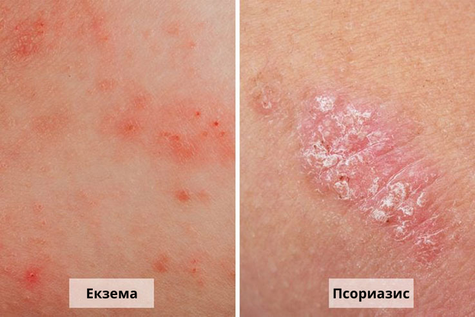 ECZEMA AND PSORIASIS